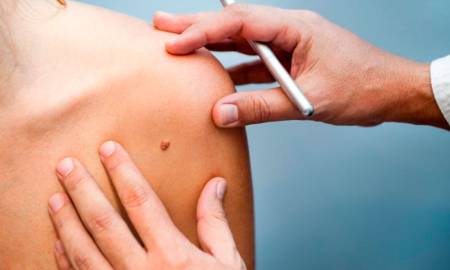 Argentina será el primer país en usar una vacuna contra el cáncer de piel más agresivo